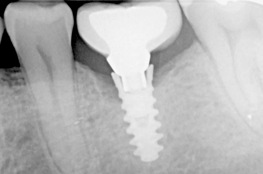 Radiografía de un implante con su corona: entre los dos se ve el escalón del mal ajuste