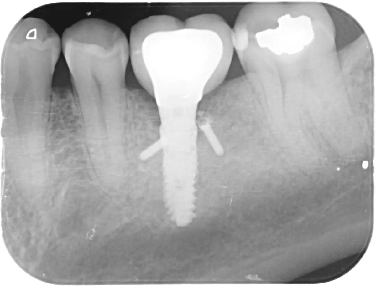 Radiografía del implante nuevo, recto y con hueso alrededor, junto a los dientes vecinos
